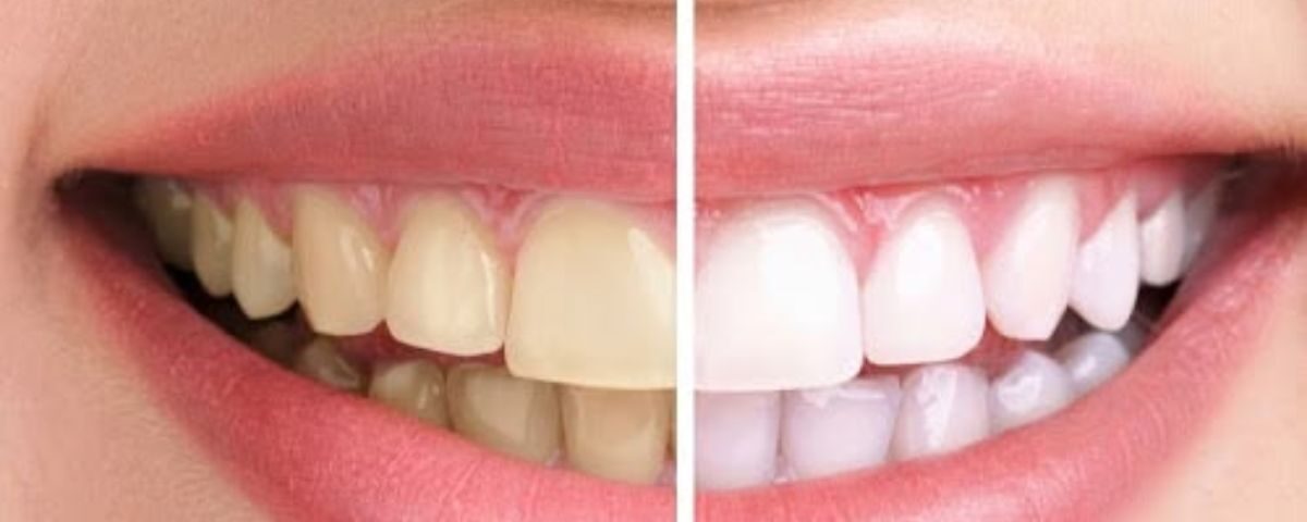 teeth whitening