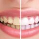 teeth whitening