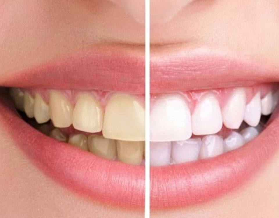 teeth whitening