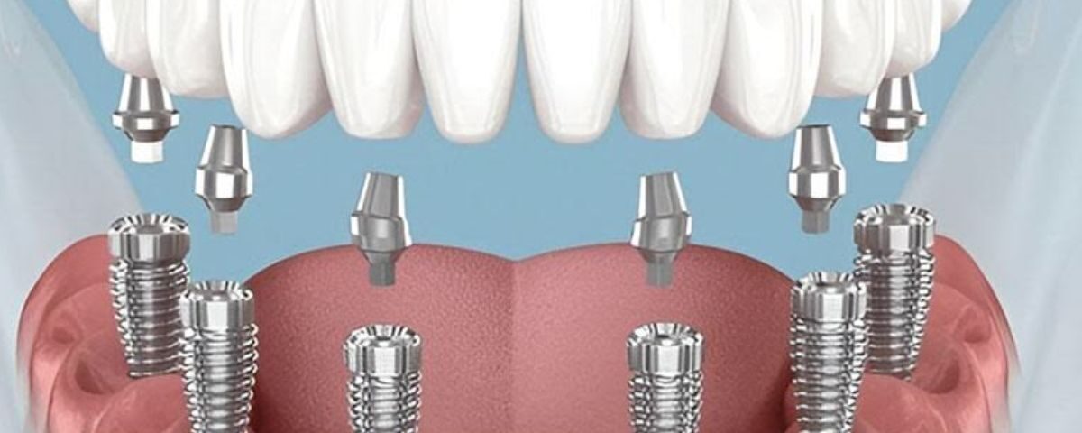 Dental Implants