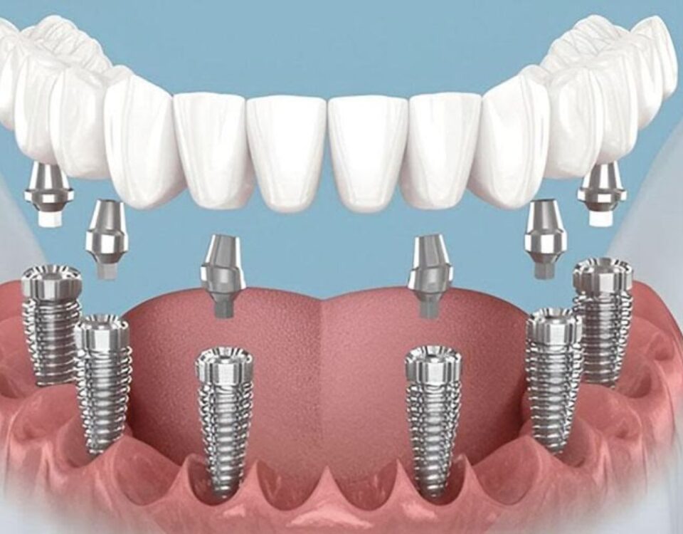 Dental Implants